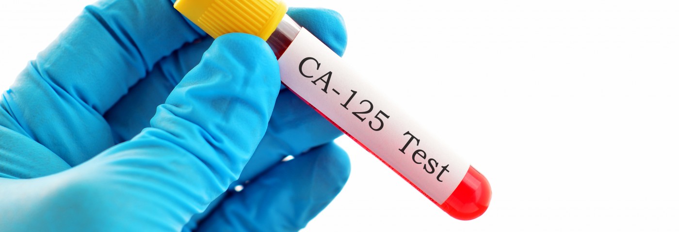 CA125 Levels in Mesothelioma Patients May Be Biomarker of Overall Survival and Chemotherapy Response