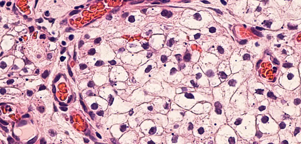 Mesothelioma Tumor Cells Can Generate Their Own Vasculature, Study Finds