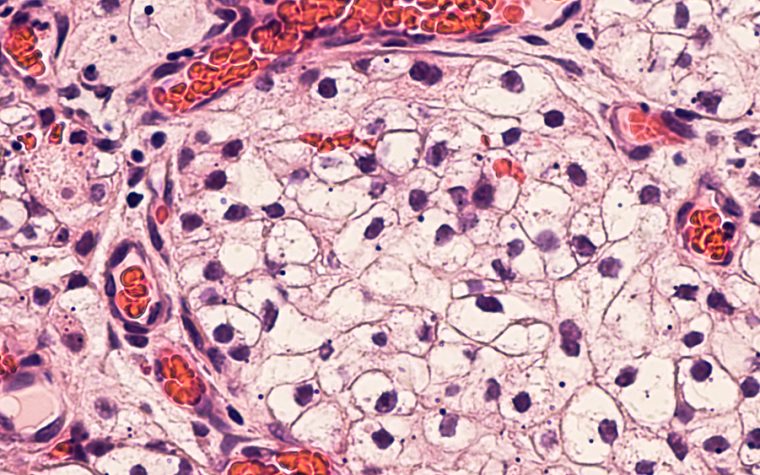 mesothelioma tumor cells