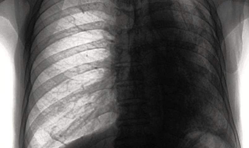 Nearly Half of Patients with Negative CT Scans Have Pleural Malignancy, Study Finds