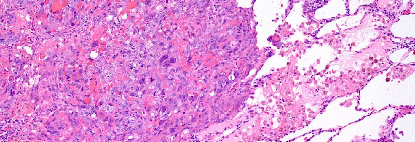 New Tissue Imaging and Collecting Technique Can Identify Mesothelioma Subtypes