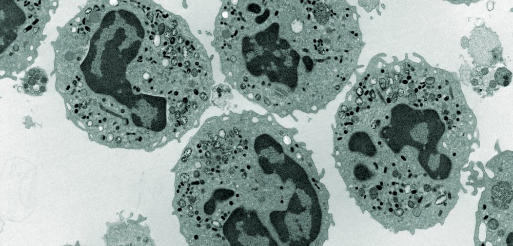 Electron Microscopy Still a Valuable Tool for Diagnosing Mesothelioma, Researchers Argue